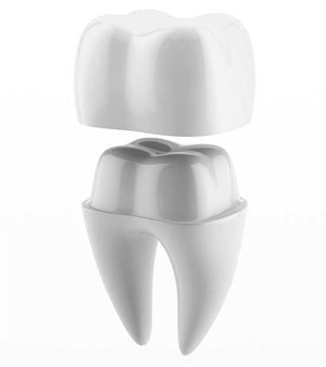 Dental Crowns Image
